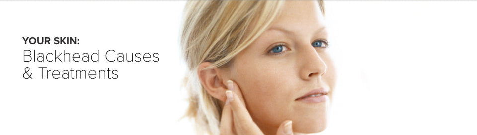 What Causes Blackheads