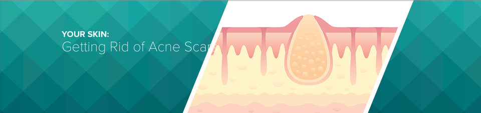 Scars are Unwelcome Souvenirs of Acne: How to Prevent Acne Scars & How to Reduce the Appearance of Acne Marks