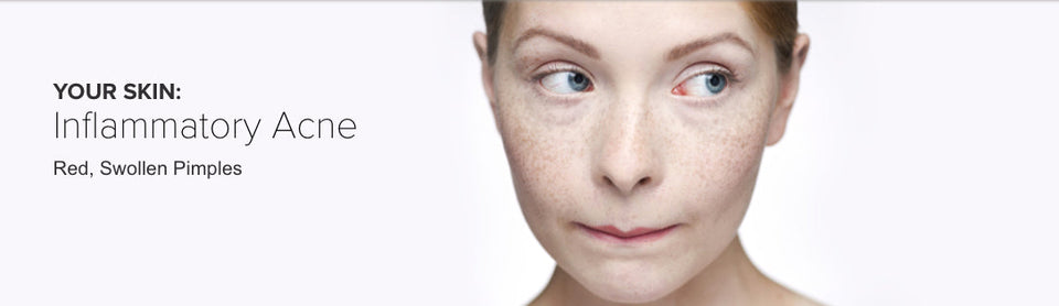 Red, Swollen Pimples