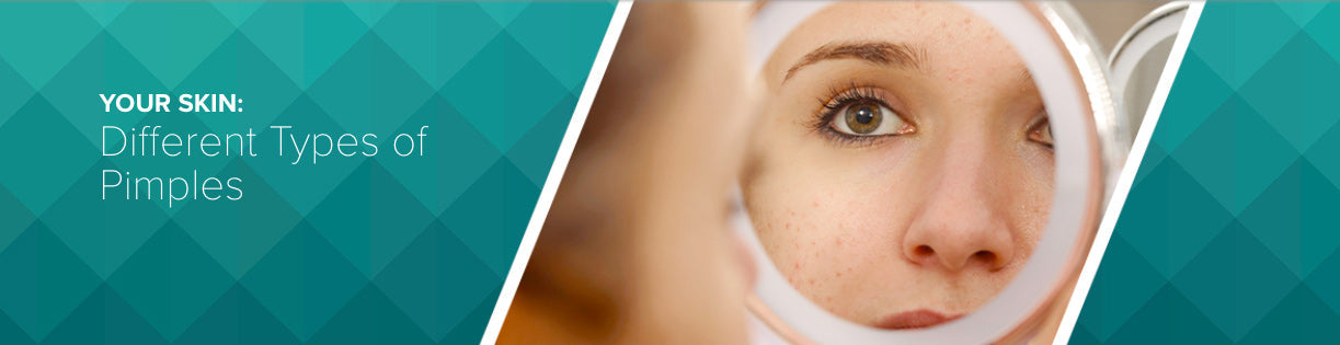 What Kind of Acne Do You Have?